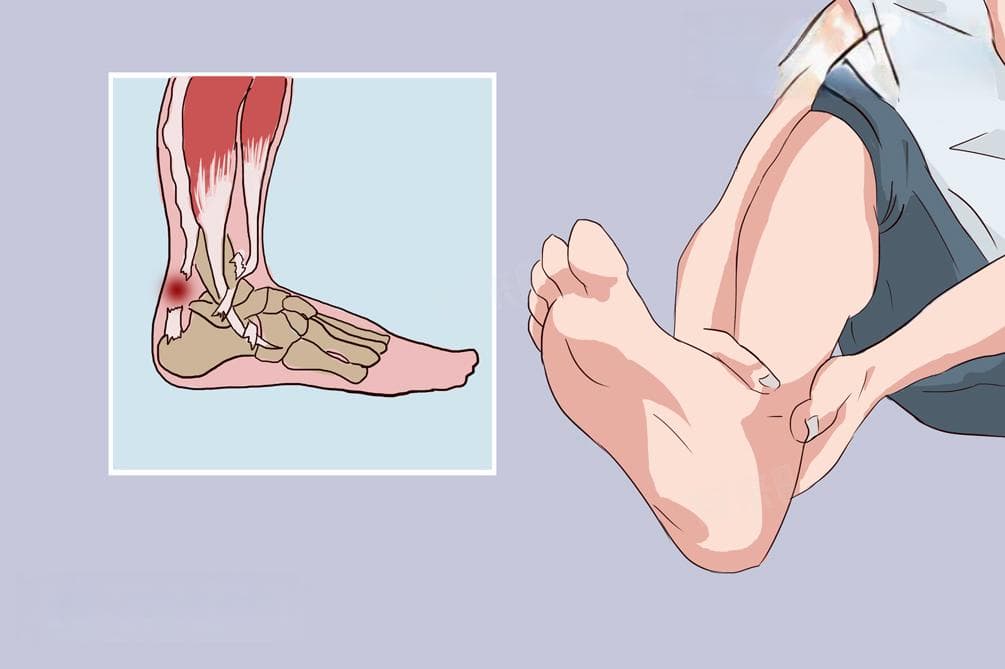 跟腱断裂是什么表现