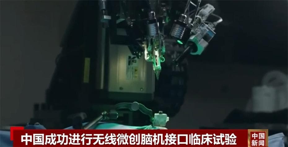 清华大学完成两例无线微创脑机接口临床试验，患者已能实现意念控制