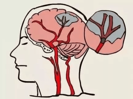 专家解读：脑卒中后的康复治疗全攻略