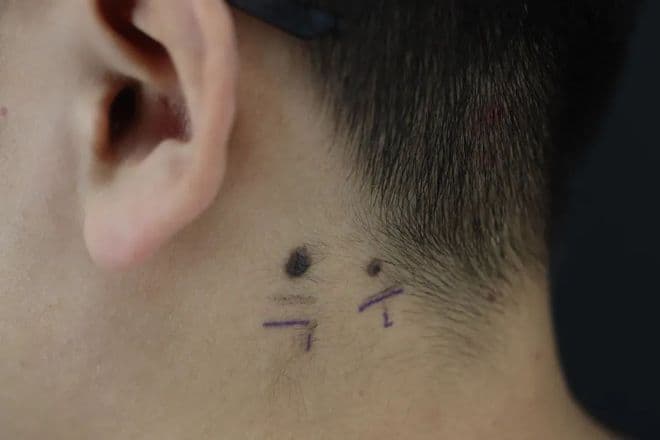 警惕“黑痣”癌变风险：黑色素瘤的早期信号与治疗方法