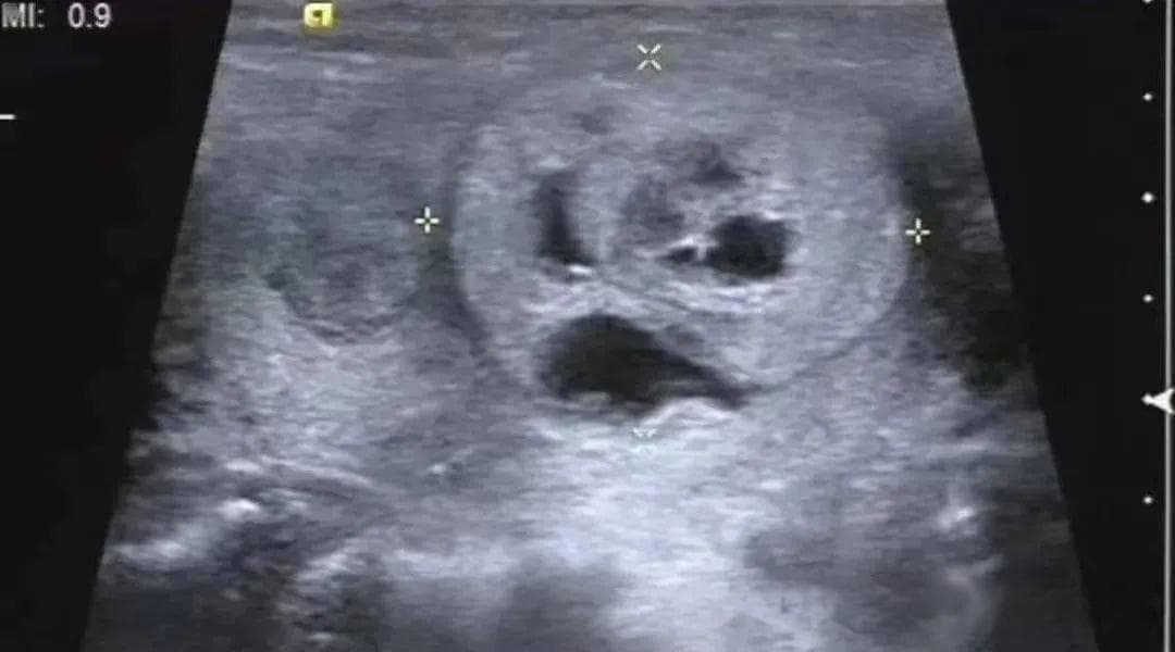 一文读懂甲状腺结节分级：ACR TI-RADS标准详解