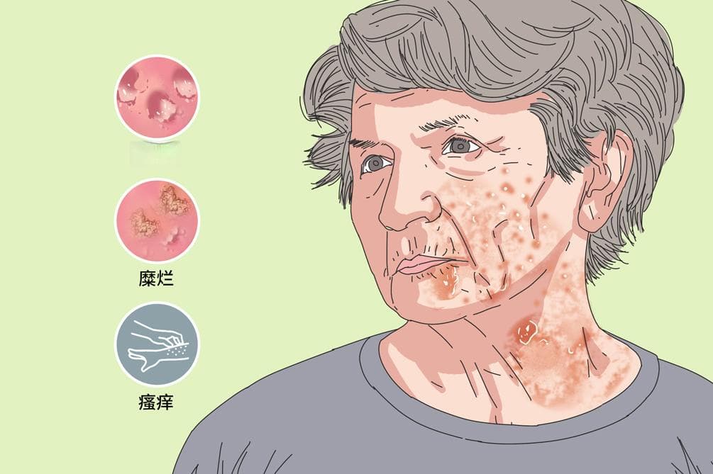 泛发性湿疹：病因、症状、治疗与预防全解析