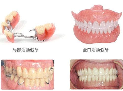 牙友提问解答！不拔牙根可以装活动假牙吗？牙根稳固没病变就可以|方法多样注意风险！