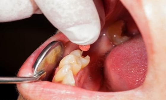 根管治疗的效果怎么样？如何衡量根管治疗的疗效？