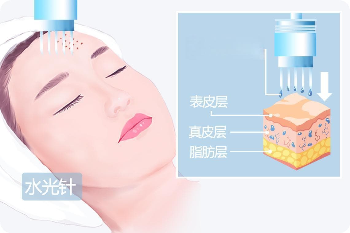 水光针的副作用和危害有哪些