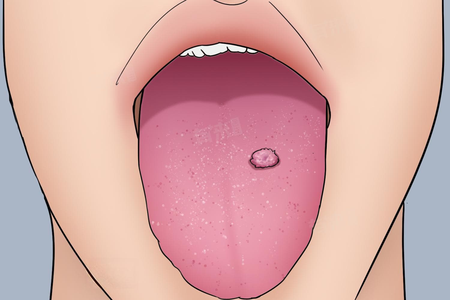 舌头根部长了凸起肉粒并有异物感怎么办？