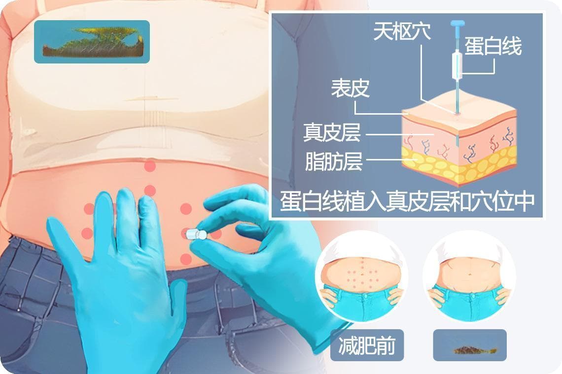 埋线减肥的原理和作用有哪些