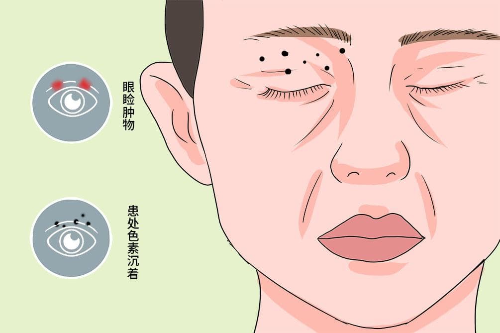 切除黑色素痣需要住院吗