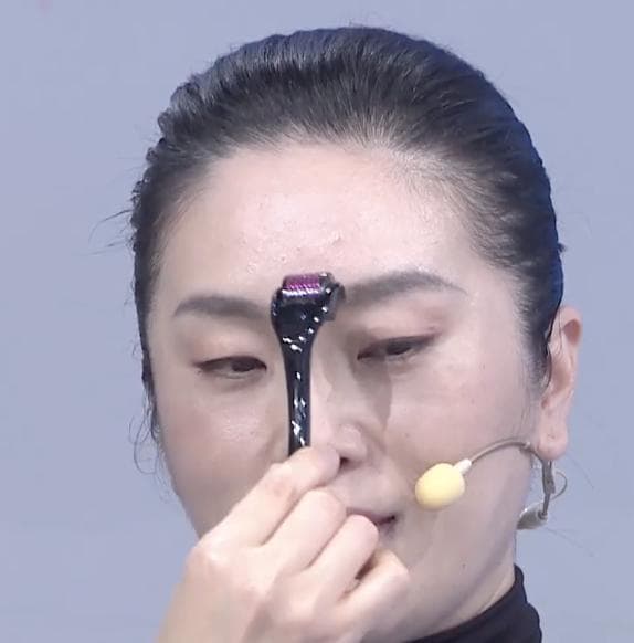 针灸治头痛：4种常见类型及对应穴位详解