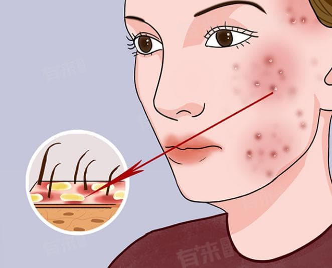 脸上有油是什么原因引起的