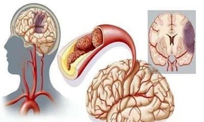 腔梗是脑梗吗，会不会偏瘫怎么治疗？腔梗和脑梗的区别一文全知道