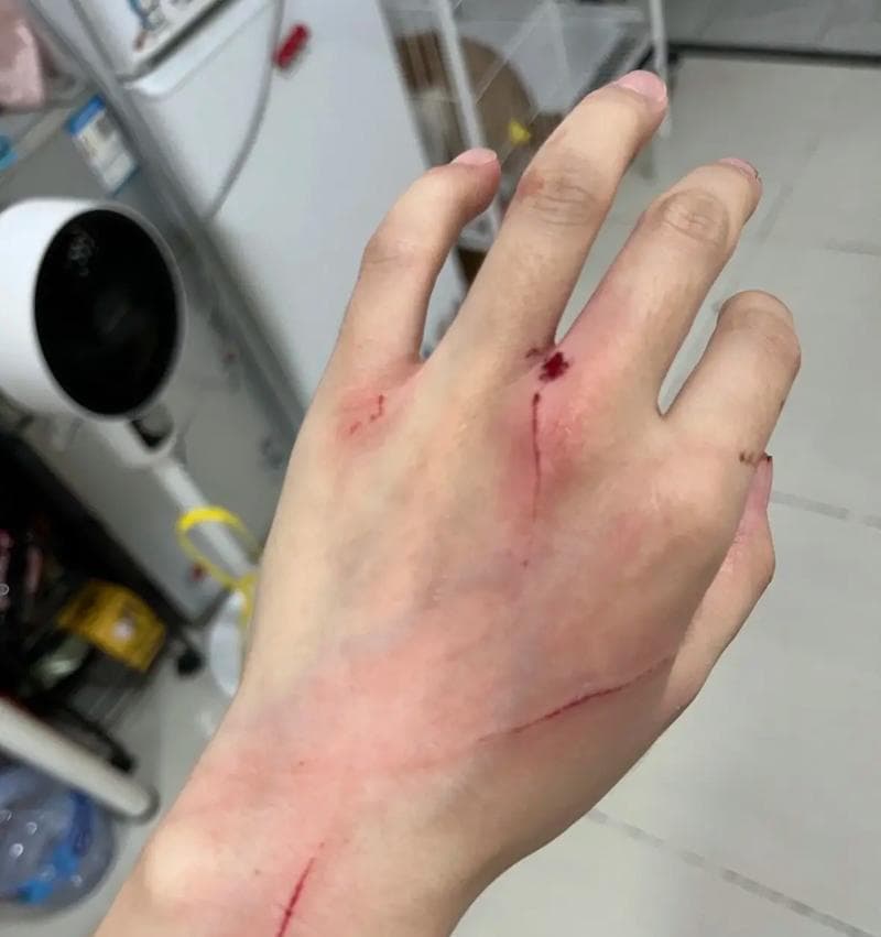 被猫抓伤后应如何处理伤口？