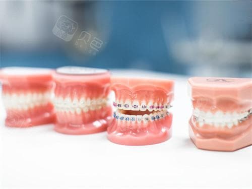 牙齿二次正畸意义大吗？非常有必要！提高口腔健康|改善咬合功能|提升社交自信！