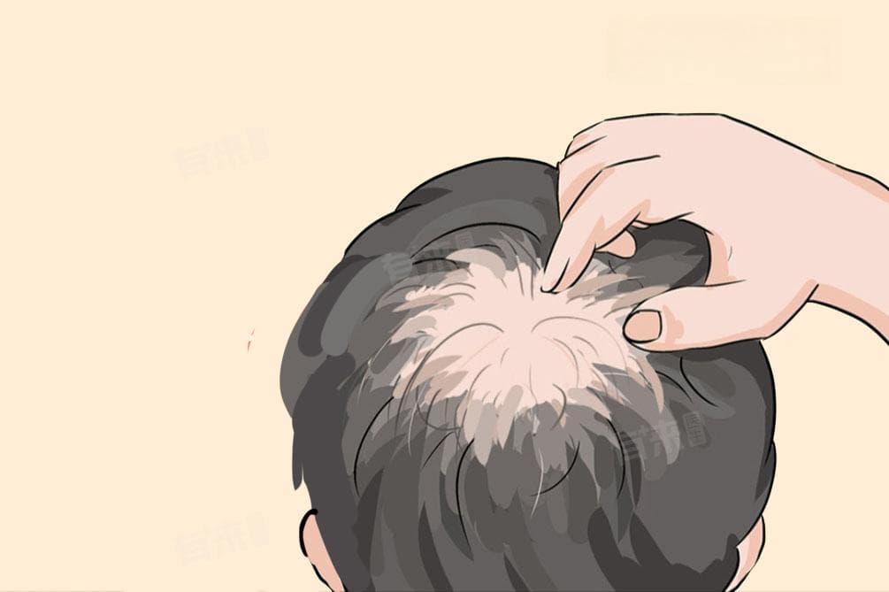 脂溢性脱发该如何治疗