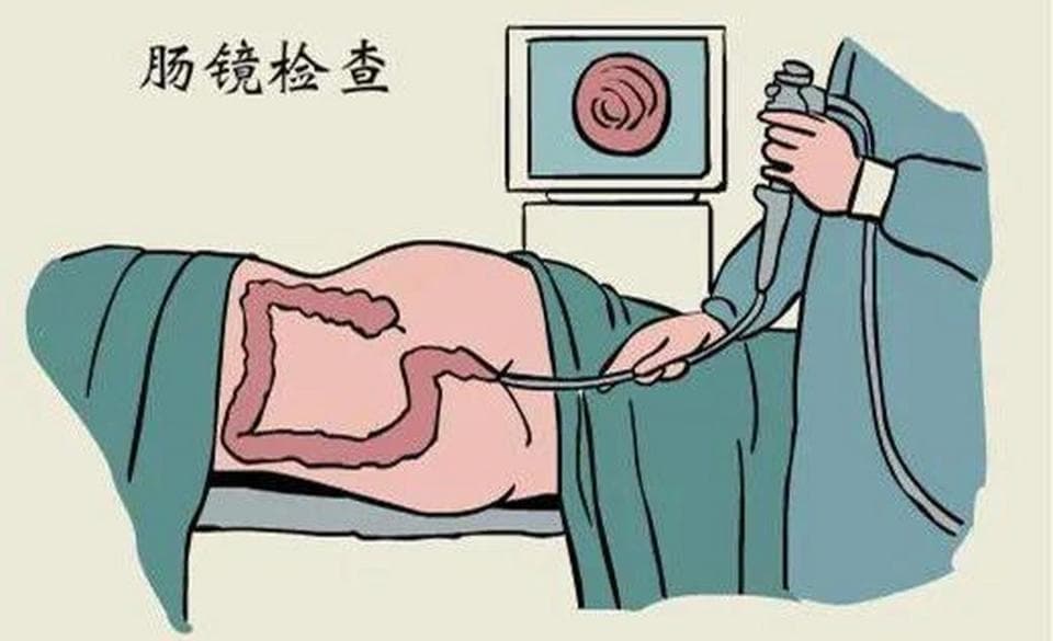 肠镜检查你了解多少？身体出现这些症状，快去检查，预防这些疾病