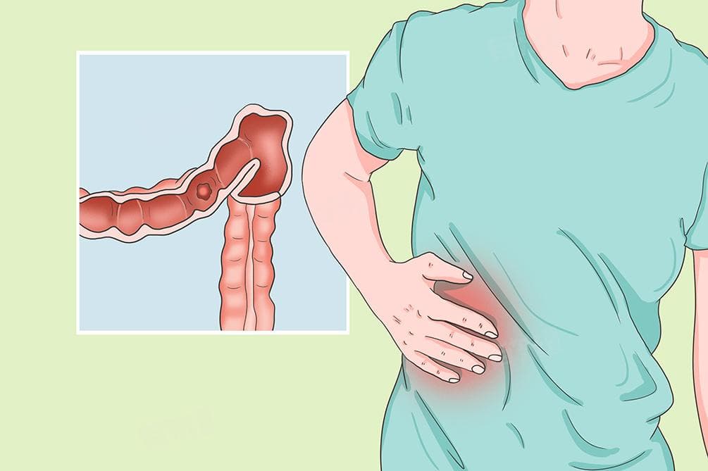 右腹部疼痛的鉴别方法