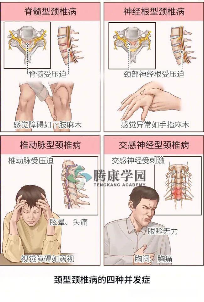 颈肩疼痛、脖子僵？当心颈型颈椎病“来袭”！