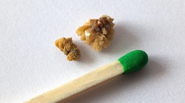 泥沙样结石该怎么治疗