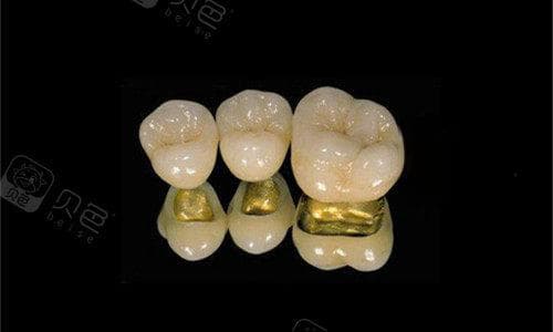 烤瓷牙口臭像臭水沟味？原因及有效处理方法大揭秘！
