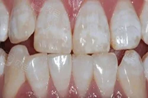 氟斑牙怎么才能变白？牙医美白后还会变黄吗？实用经验分享