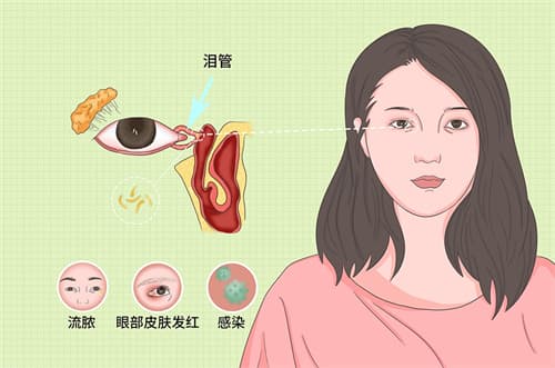 泪管堵塞有什么症状？新生儿、中老年人的治疗方法均有不同！