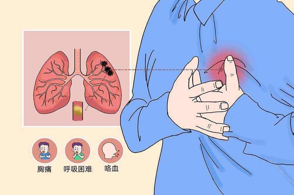 肺栓塞的早期症状和前兆