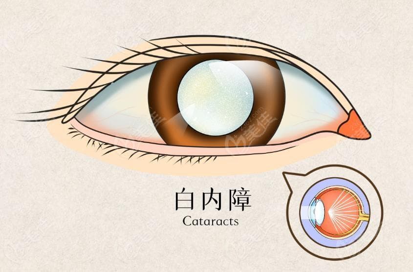 白内障手术是超声乳化好还是飞秒激光好?对比费用/成效区别,做飞秒更好