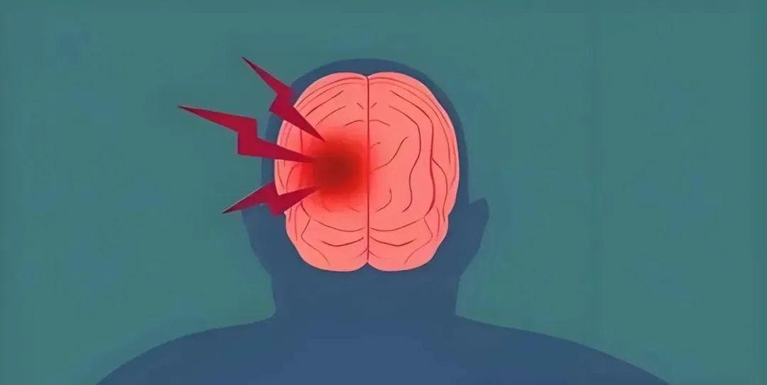 新研究：干细胞疗法对改善中风后运动功能效果显著