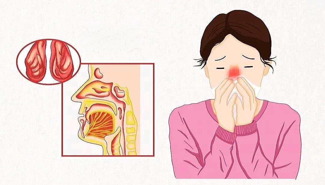 治疗过敏性鼻炎的10个用药方案