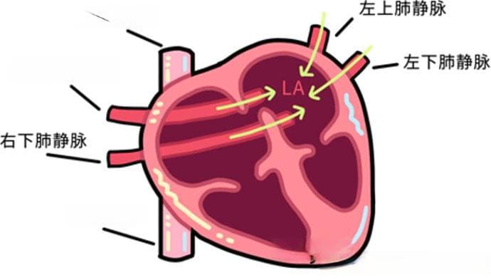 迷路的肺静脉——完全性肺静脉异位引流解读