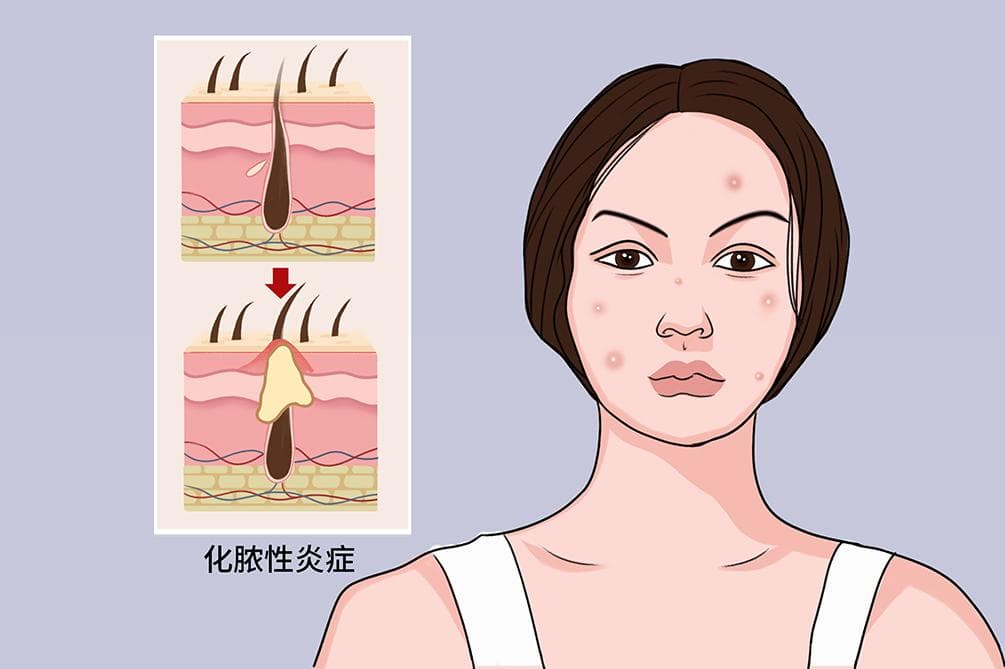 毛囊炎的克星药