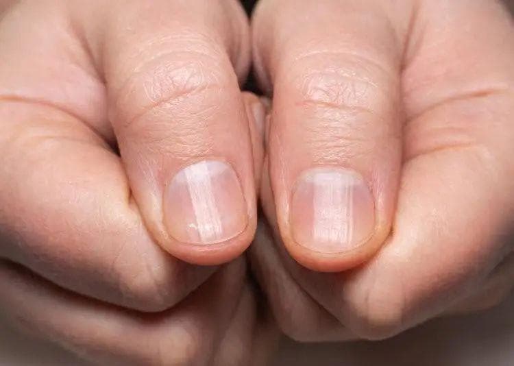 提醒：指甲出现竖纹，和这些原因有关，多留意