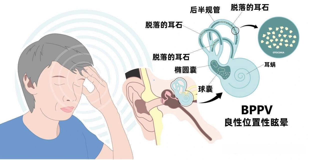 头晕目眩？当心是耳石症！六大治疗方案助你摆脱困扰