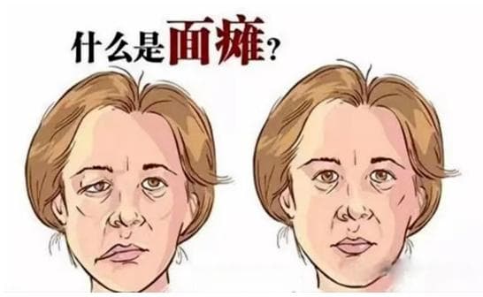 秋季，警惕面瘫来袭——面瘫病防治注意事项