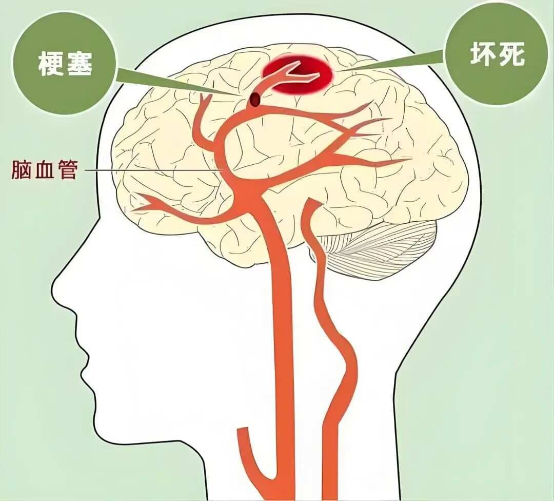 脑供血不足，经常头痛眩晕耳鸣、肢体麻木，10个用药方案来帮您