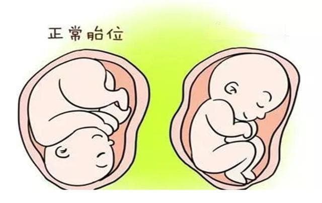 胎位不正，还能顺产吗？听听专业医生怎么说