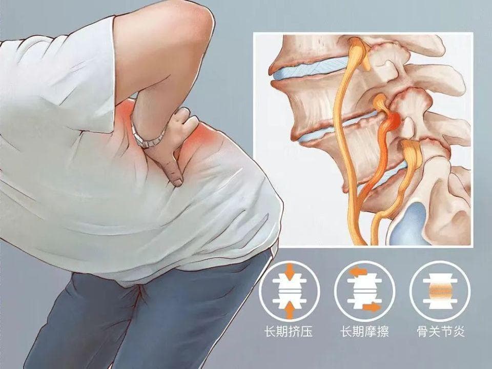 【朝医科普】大夫，长骨刺了怎么办