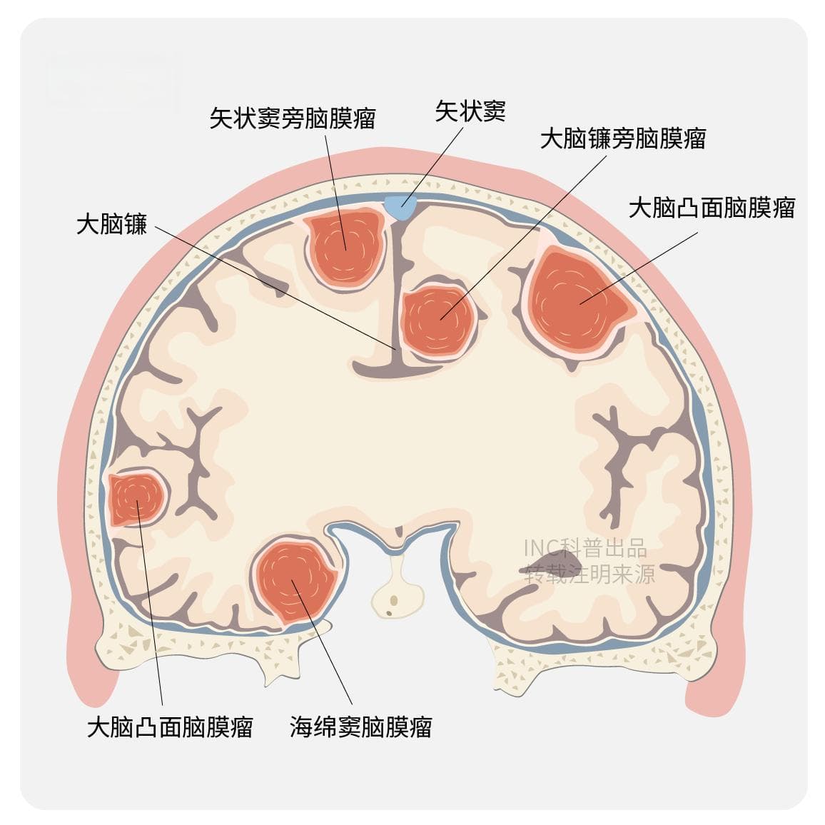 脑膜瘤好发部位有哪些？如何治疗脑膜瘤？