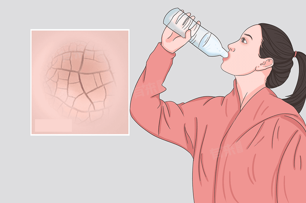 干燥综合征：病因、症状、治疗与预防全解析