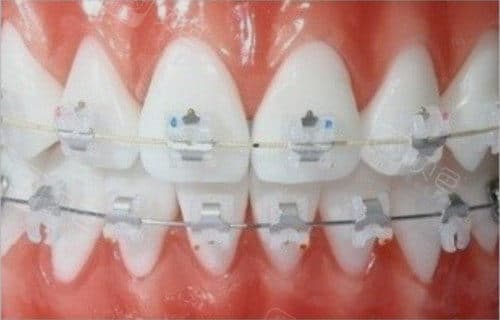 单看骨性嘴凸和牙性嘴凸对比图难以区分？那就来学学实用的辨识方法来做判断吧！