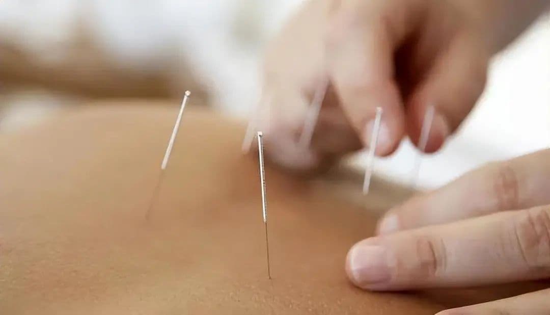 针灸时突然晕倒？了解一下“晕针”现象