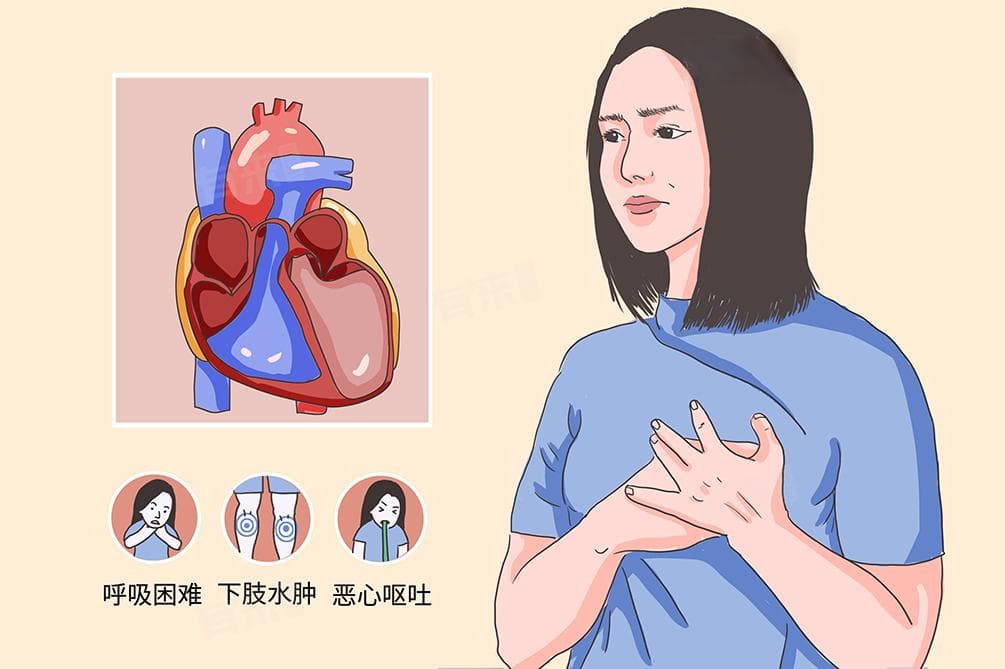 右心衰竭的最典型体征及护理方法