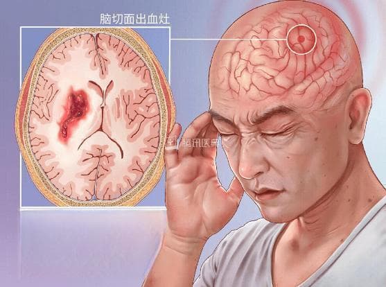 脑出血后遗症中医中药怎么调理治疗？