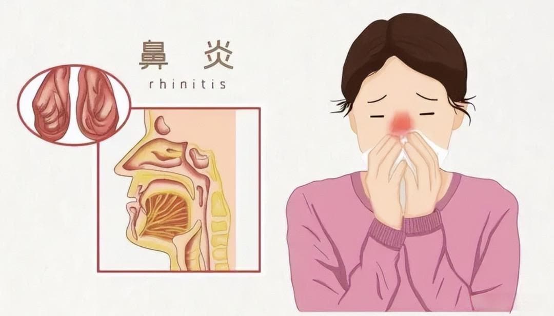 过敏性鼻炎高发！如何守护鼻腔健康