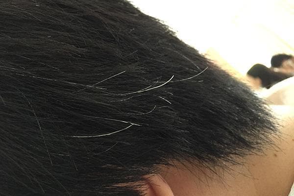 年轻人为什么会有白头发？黄伟智医师