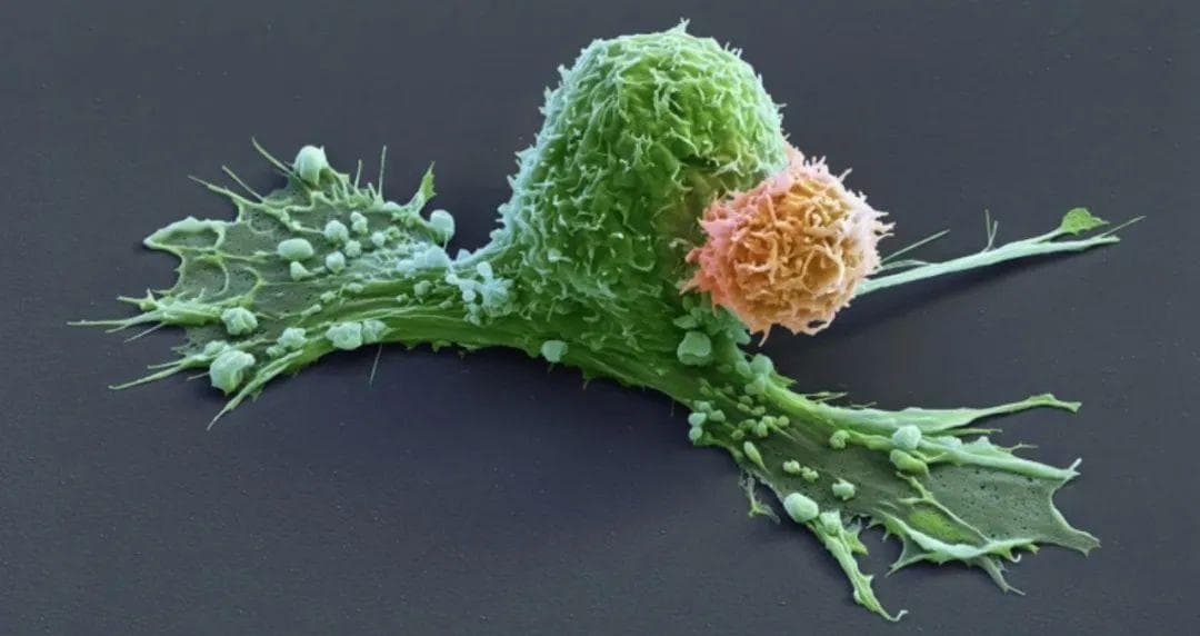 Nature头条：CAR-T细胞疗法让致命脑肿瘤患者无癌生存超18年