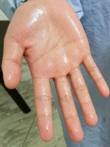 手汗症的病因、诊断与鉴别诊断