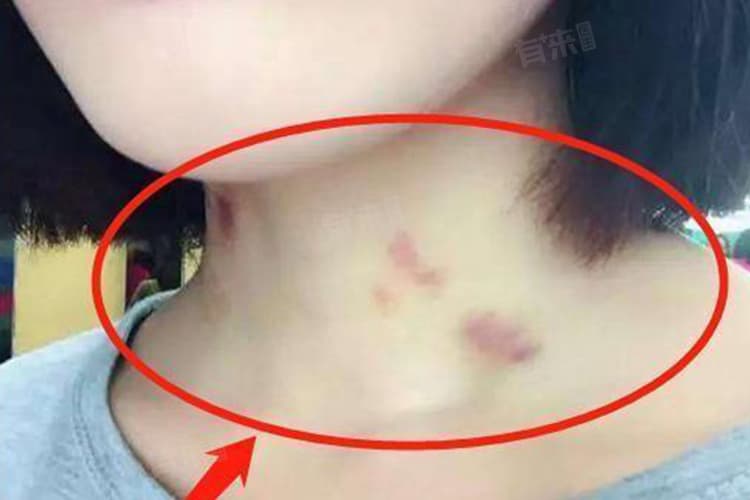 脖子上的草莓印怎样可以快速消除