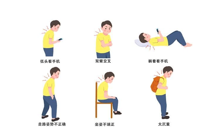 守护青春脊梁：青少年特发性脊柱侧弯的预防与治疗