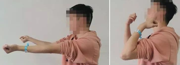 异位骨化的预防与治疗